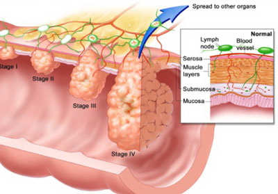 Can Probiotics Reduce your Risk of Cancer?